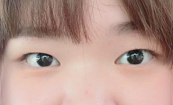 ก่อนแก้ไขกล้ามเนื้อตาอ่อนแรง
