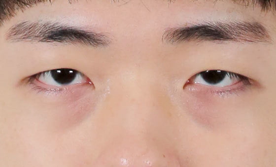ก่อนศัลยกรรมใต้ตา