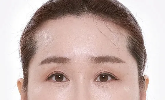 หลังยกคิ้วและหน้าผาก