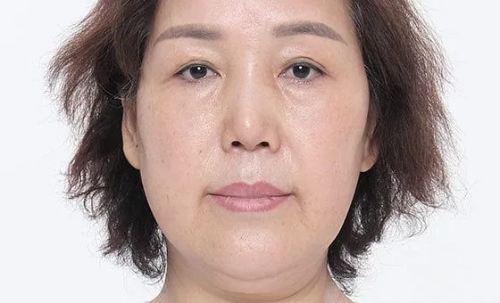 ก่อนดึงใบหน้าส่วนล่าง