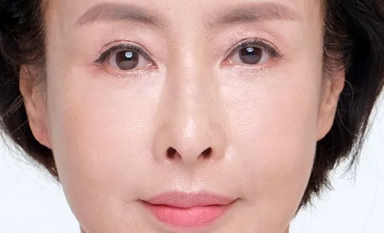 หลังยกกลางใบหน้า