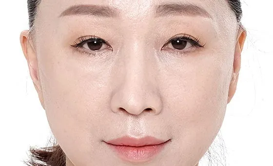 หลังยกกลางใบหน้า